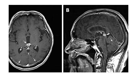 Pineal Gland, Sagittal MRI Stock Image C030/6313