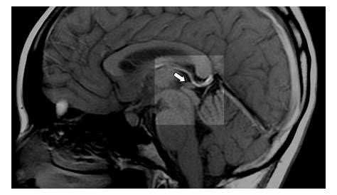 Pineal Gland Mri Tumour, MRI Scan Stock Image M134/0891