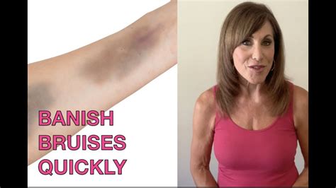 Pineapple Bromelain Bruises