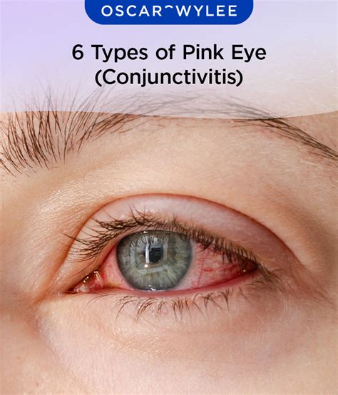 pink 6 eye