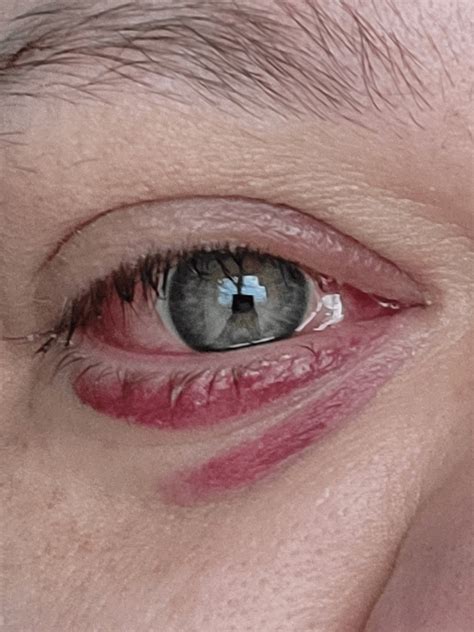 pink eye 3