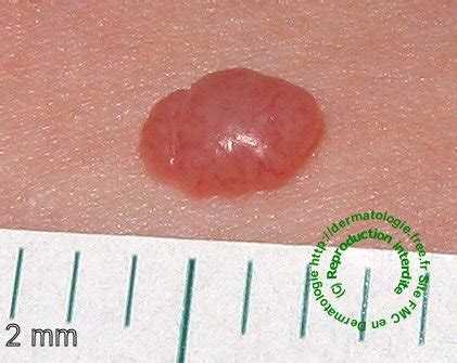 pink nodular melanoma pictures