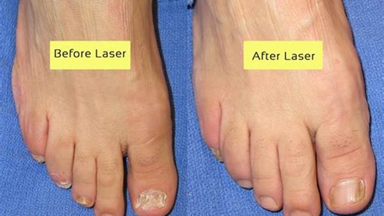 Pinpoint Laser for Toenail Fungus