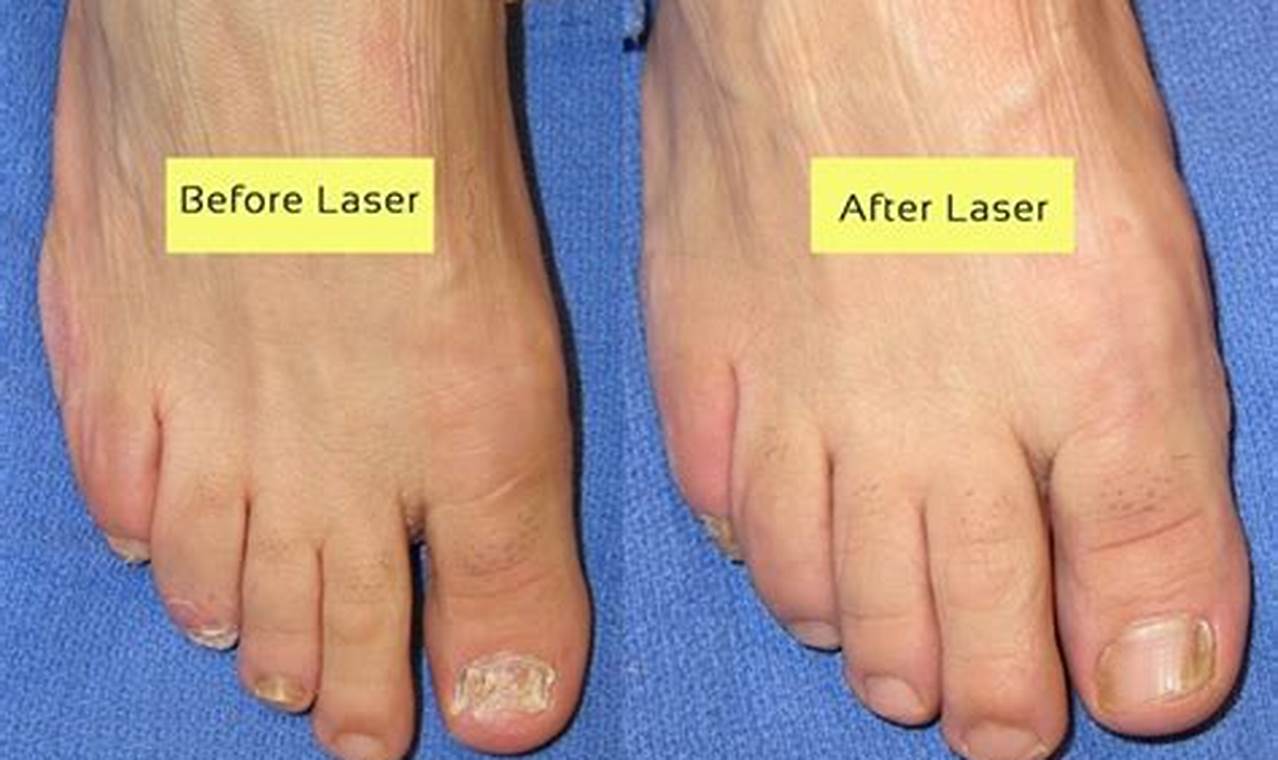 Pinpoint Laser for Toenail Fungus