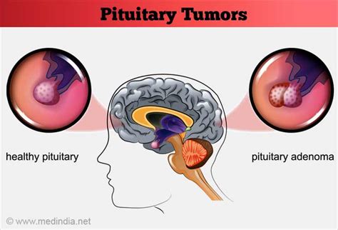 pituitary gland tumor