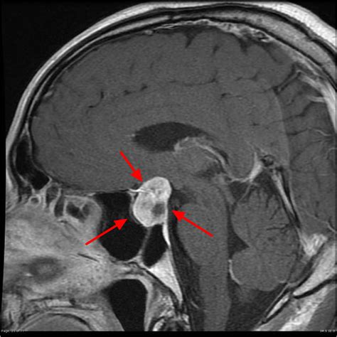 pituitary microadenoma