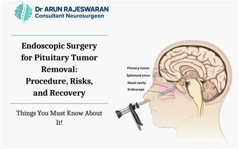 pituitary tumor doctor