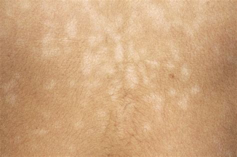 Pityriasis Versicolor
