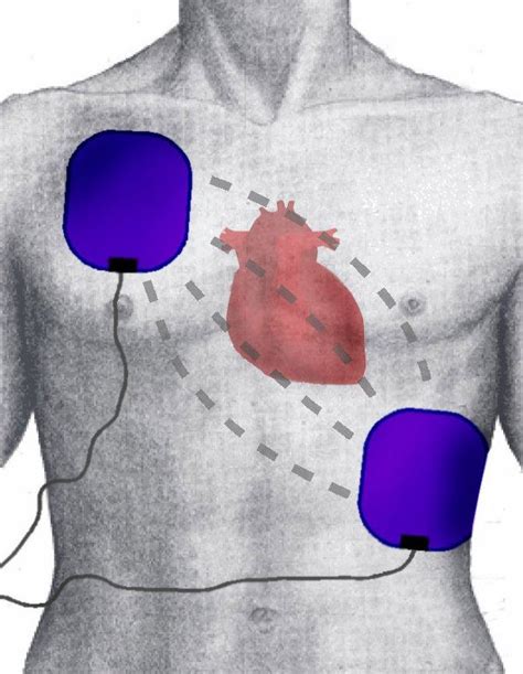 Placement Of Electrodes In Defibrillator