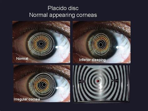placido disc principle