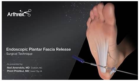 Plantar fascia release Surgical Technique OrthOracle
