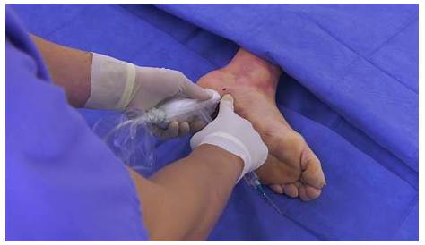 Plantar Fasciitis Surgery Incision Abscess Drainage & Drainage Wound