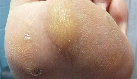 Plantar Wart After Treatment Severe s In An Patient NEJM