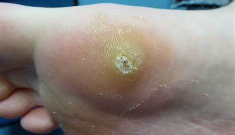 Plantar Wart On Big Toe. Visible Black Dots Warts. Stock