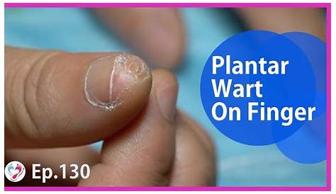 Plantar Wart On Finger Hurts My Son's s. Popping
