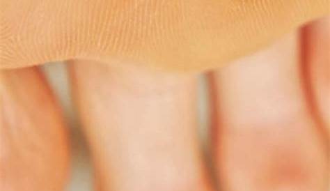 Plantar wart removal stages How to get rid of warts fast
