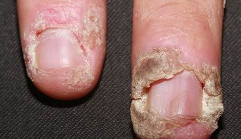 Plantar Wart On Fingernail Dr Joseph Chalissery WHAT ARE WARTS???