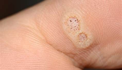 Multiple Photos Of A Palmer Wart On The Finger Of A