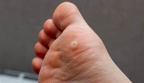 Plantar Wart On Childs Foot Stock Photo Image of