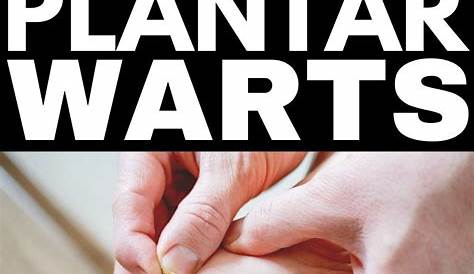 How to Get Rid of Plantar Warts Top 10 Home Remedies