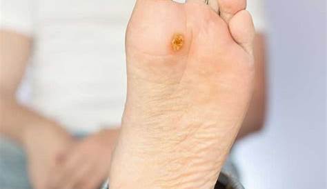 Plantar Wart On Foot Removal Callus/ Surgery 8 Month Update