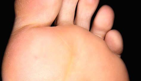 Plantar Wart On Foot Turned Black Changing Color After Or During Treatment