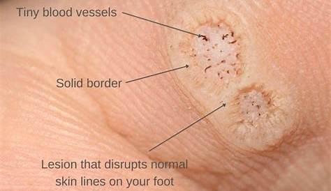 Plantar wart on foot wont go away Best Skin images in