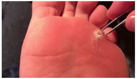 Plantar Wart Removal Photos Ses Of With Salicylic Acid Tutorial