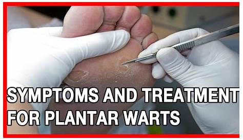 Plantar Wart Treatment Pictures Holistic Therapy Connections Of A