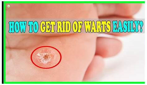 Wart Remover Pads, Remove Plantar and Common Warts