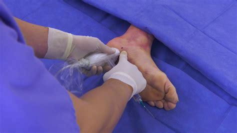 When Plantar Fasciitis Surgery is Necessary: Understanding Your Treatment Options