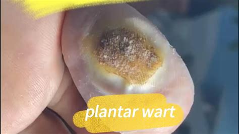 Planters Wart Surgery