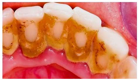 Tartre et plaque dentaire image stock. Image du dentistry
