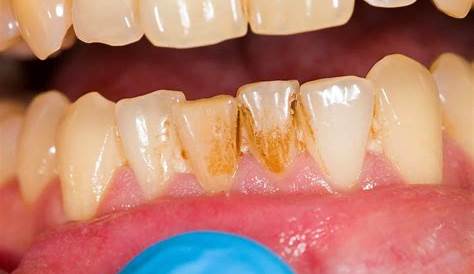 Plaque Dental Tartar (Descaling And ) Symptoms And Treatment