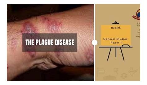 Plaque Disease Meaning In Malayalam Famous s That Are Named After People Digit