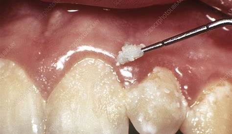 Dental tartar, plaque and gum disease Stock Image C023