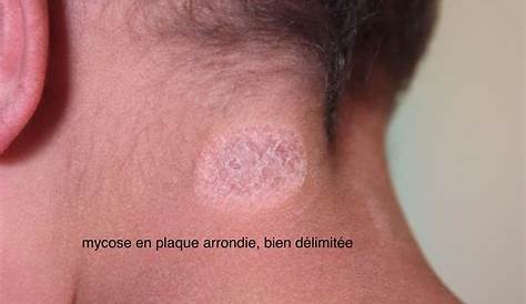 Plaque Noir Sur Le Corps Définition Vitiligo ucodémie Achromie Futura Santé