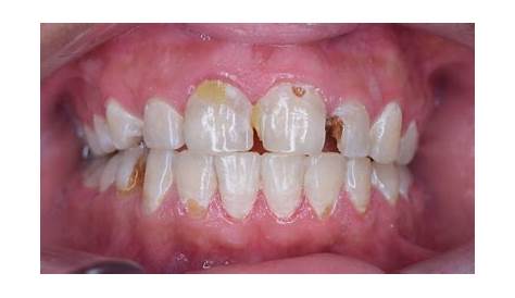 Plaque de Priestley (dents noires) sur les dents de lait