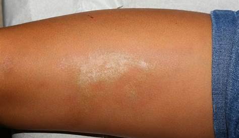 Morphea Skin, Morphea Scleroderma Causes & Treatment