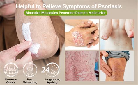 Plaque Psoriasis Cure
