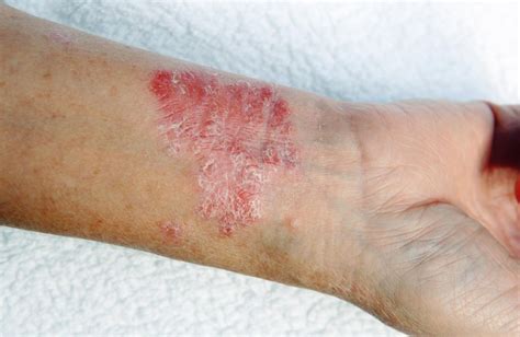 plaque psoriasis early signs pictures