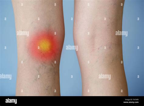 Plaque Rouge Jambe Froid