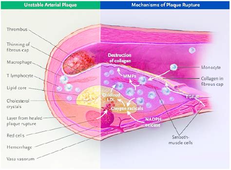 Plaque Rupture Definition