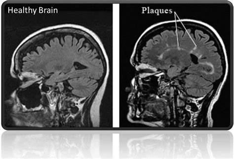 Plaques Brain Definition