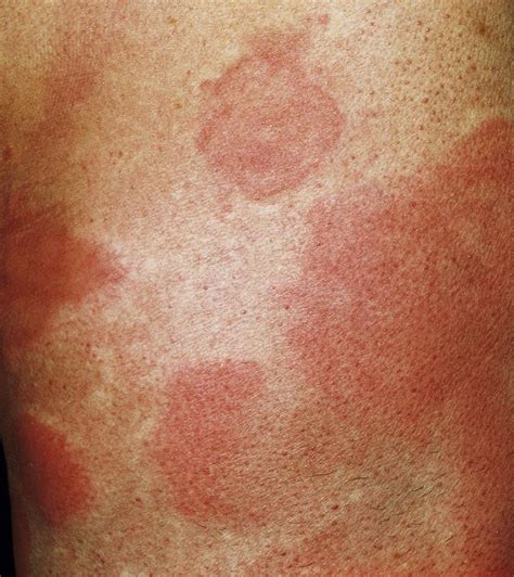 Plaques Hives
