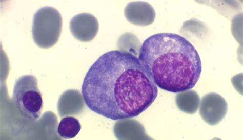 Plasmocytes Atypiques Expression Sanguine Des Lymphomes