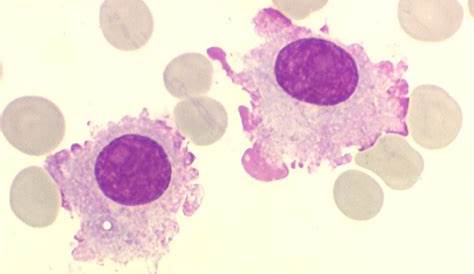 Plasmocytes Flammes ; Cellule Plasmocytaire; Cellules