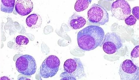 Plasmocytes Myelome Myélome Multiple Associé à Une Anémie De Biermer