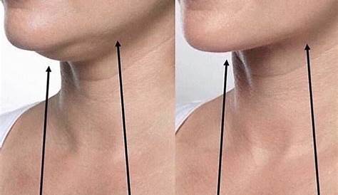 Pin by Rady Rahban, MD on Chin Augmentation | Plastic surgery, Plastic