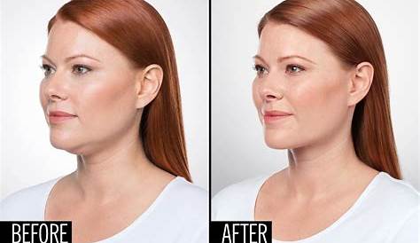 Tacoma Laser Clinic | Eliminate Your Double Chin With... | Double chin